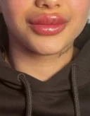 Doar pentru Femei 18 50 Ani. Tehnician de augumentarea buzelor cu acid hialuronic - imagine 2