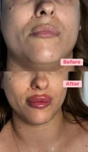 Doar pentru Femei 18 50 Ani. Tehnician de augumentarea buzelor cu acid hialuronic - imagine 3