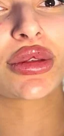 Doar pentru Femei 18 50 Ani. Tehnician de augumentarea buzelor cu acid hialuronic - imagine 4