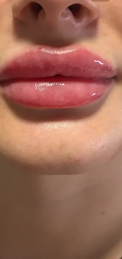 Doar pentru Femei 18 50 Ani. Tehnician de augumentarea buzelor cu acid hialuronic