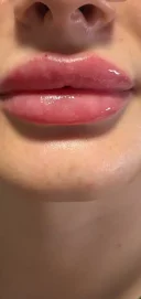 Doar pentru Femei 18 50 Ani. Tehnician de augumentarea buzelor cu acid hialuronic - imagine 5